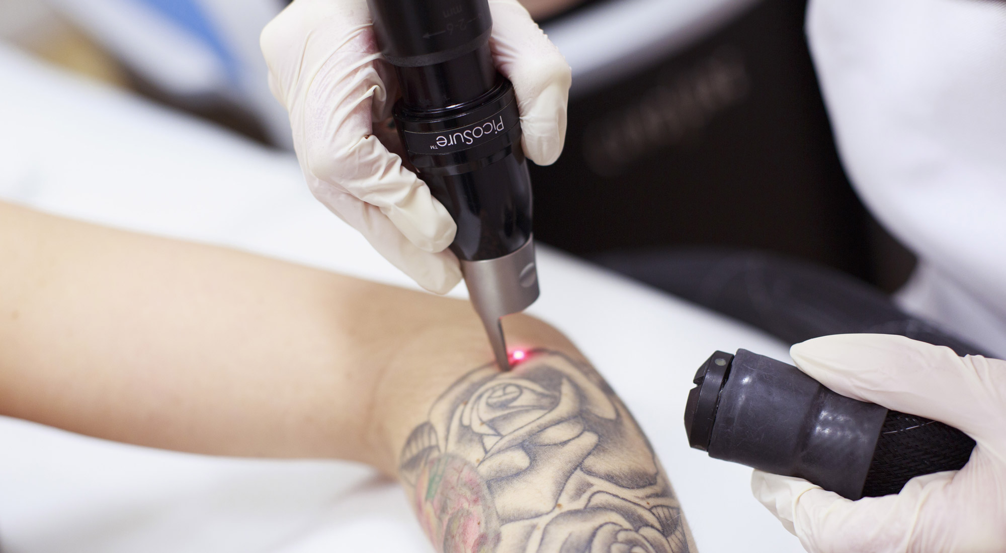 Newcastle tattoo removal